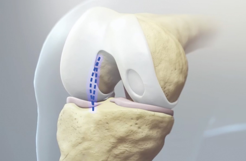 Mini Arthrotomy Delivery