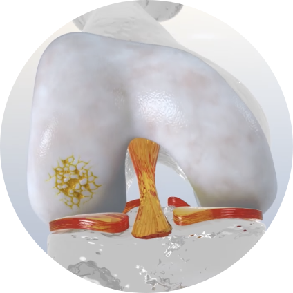 cartilage damage