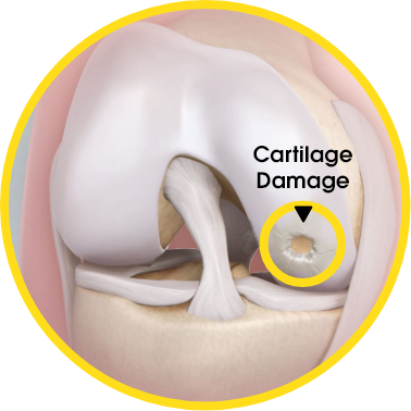 Cartilage damage