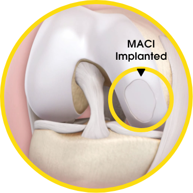 MACI Implanted 